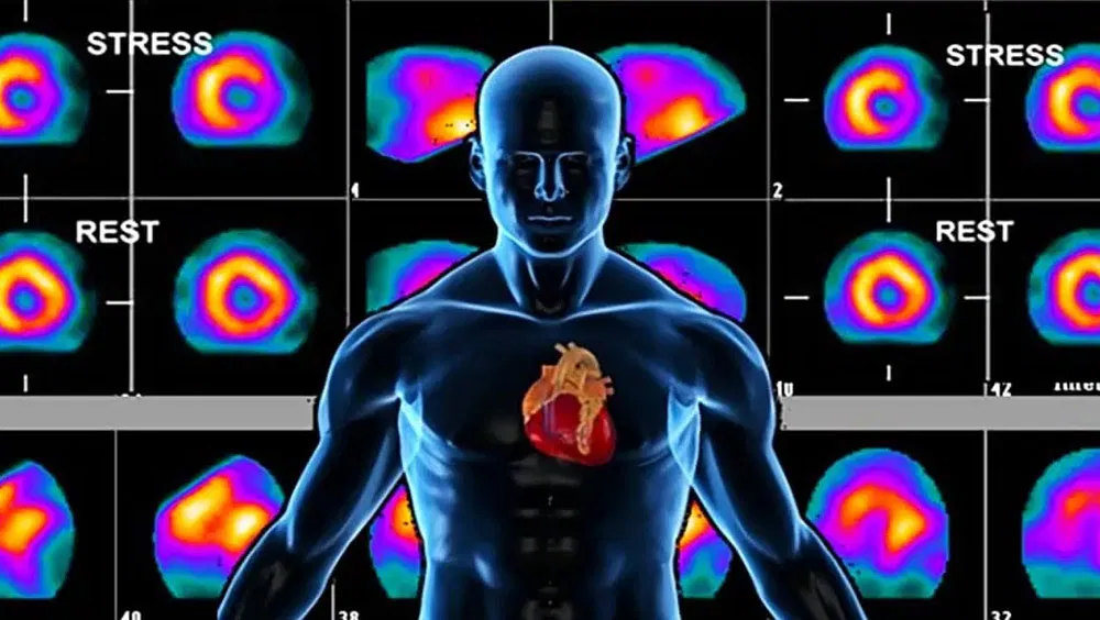 What To Expect During A Nuclear Stress Test