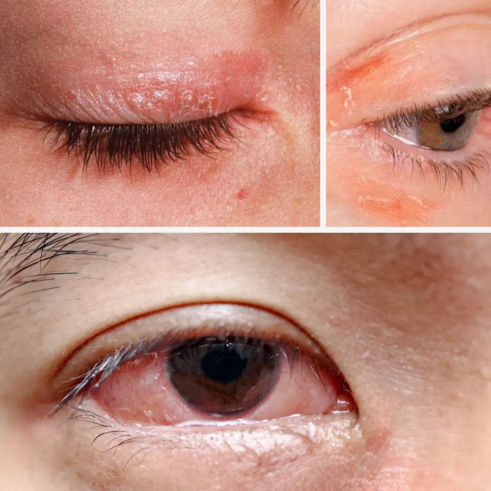 Eye Inflammation