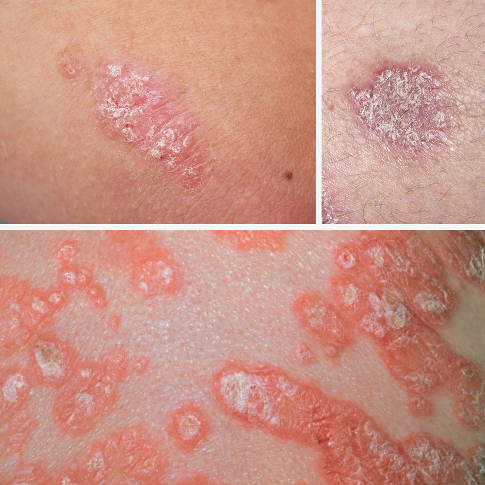 Plaque Psoriasis Symptoms   Scales on Top of Your Red Patches 1