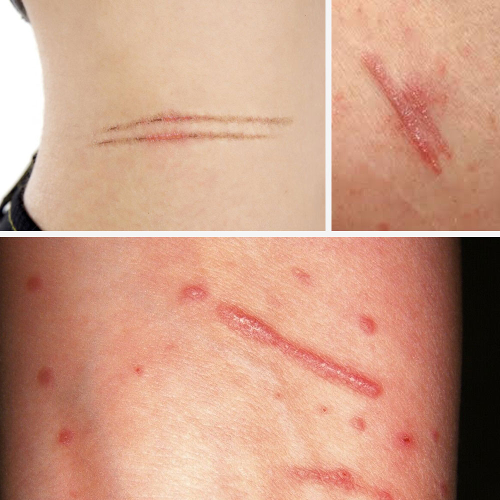 Plaque Psoriasis Symptoms  Cuts That Grow Taller