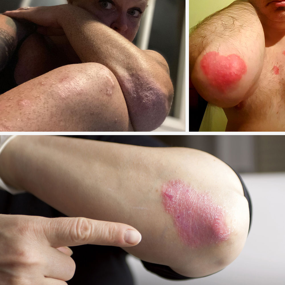 Plaque Psoriasis Symptoms  Weird Patches on Your Elbows or Knees