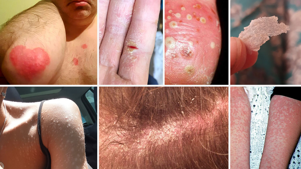 Plaque Psoriasis Symptoms That Most People Miss
