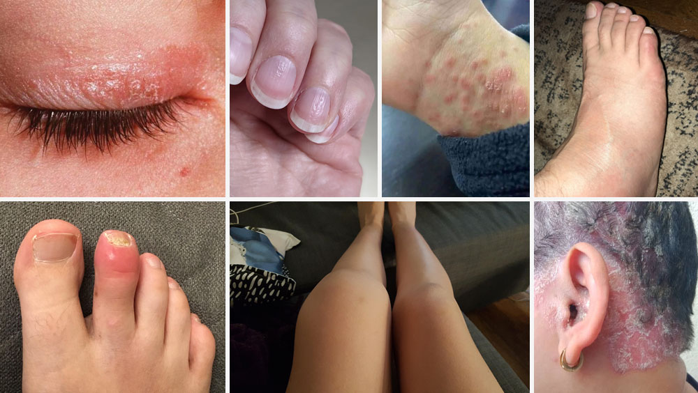 Psoriatic Arthritis Symptoms That Most People Miss