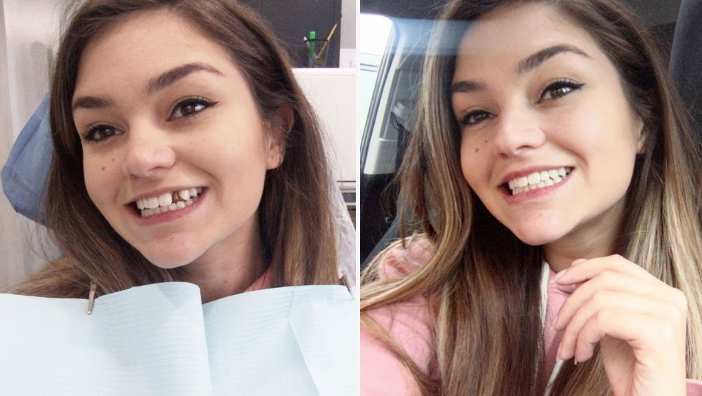 10 Advantages of Dental Implants