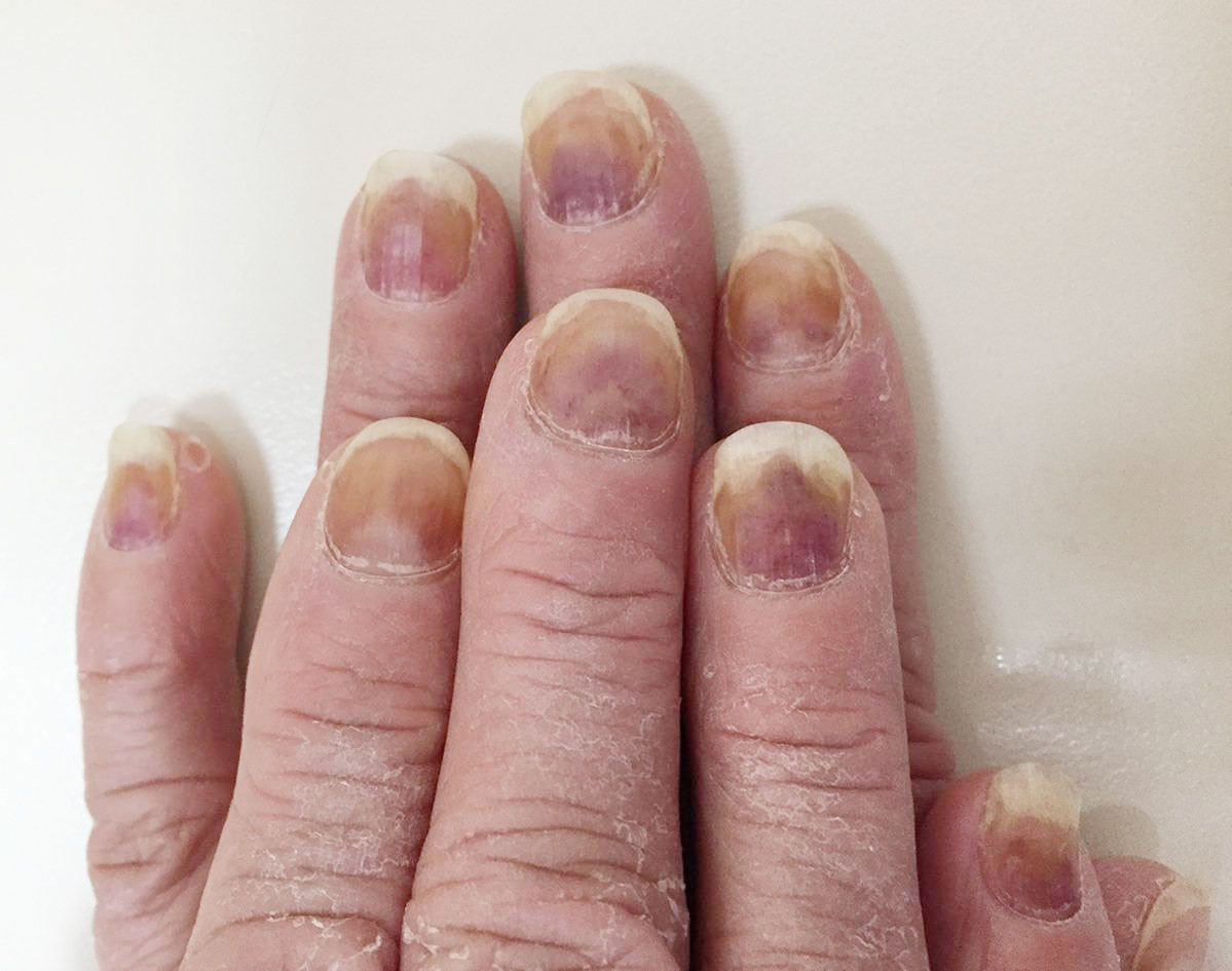 What Can Fingernail Color Mean 1
