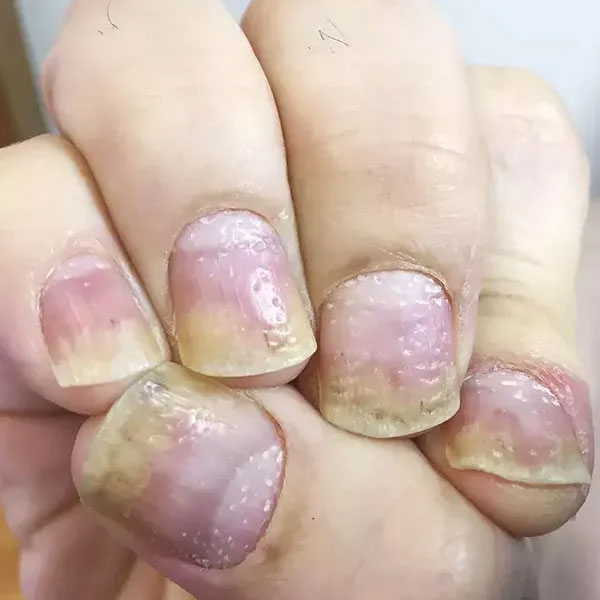 What Fingernail Texture Can Say About Your Health
