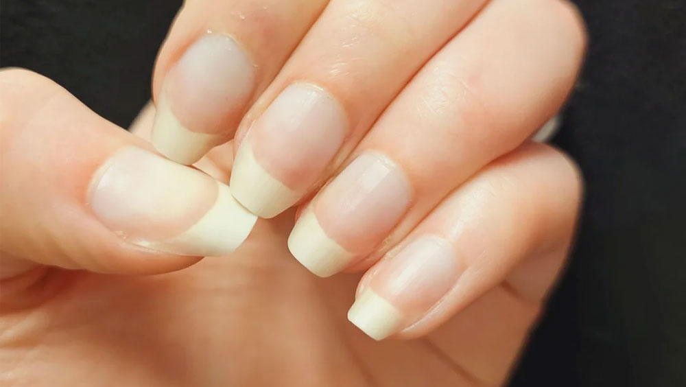 What Fingernails Can Say About Your Health