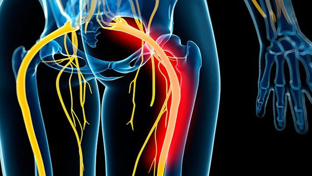 20 Tips To Relieve And Prevent Sciatica-Nerve Pain