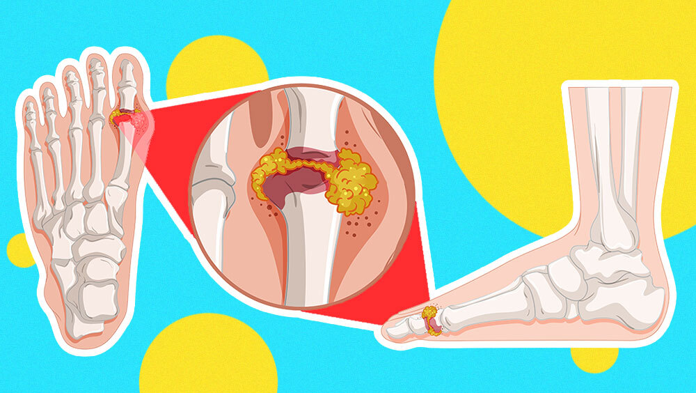 Gout Trigger Foods