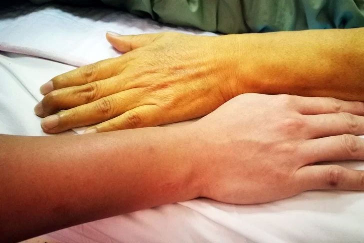 Jaundice 1