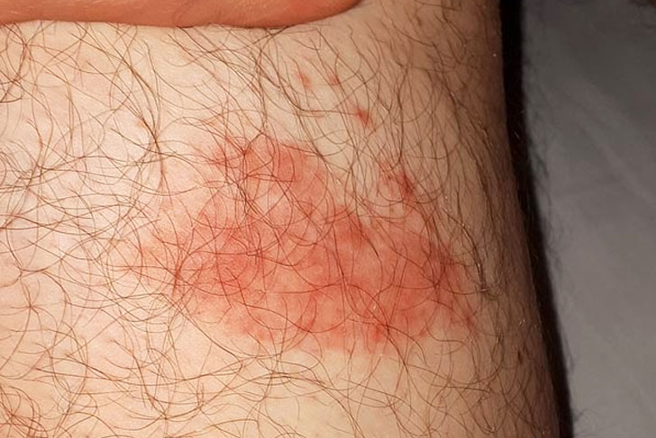 Begins at the Site of the Tick Bite After a Delay of 3 30 Days