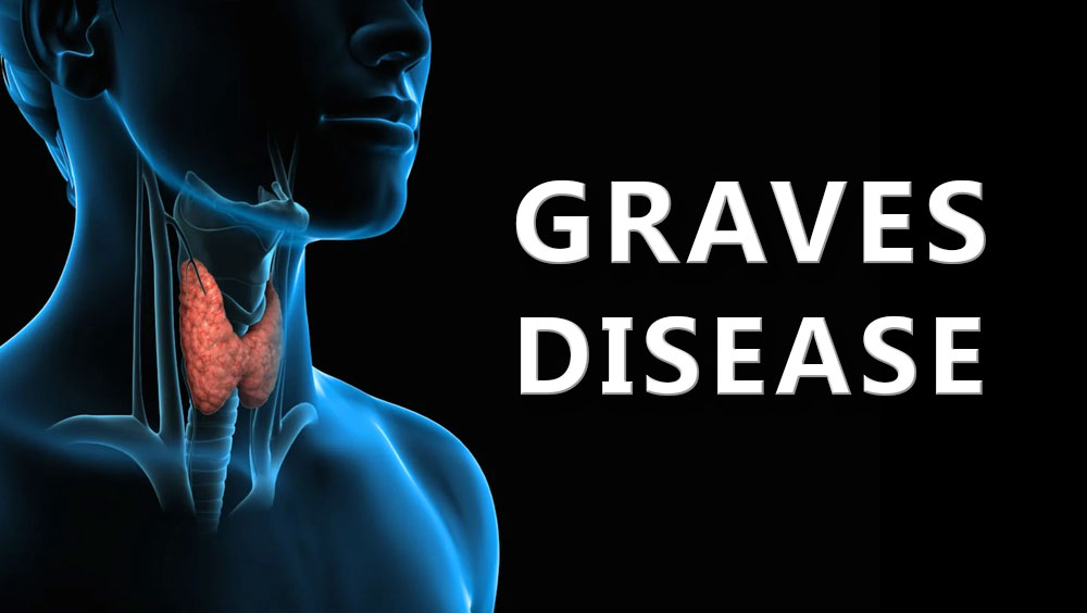Graves' Disease Symptoms