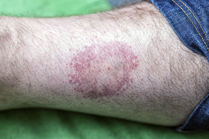 Often the Hallmark Sign of Lyme Disease