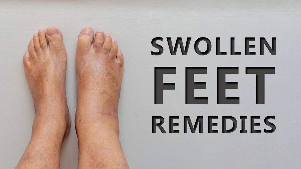 Swollen Feet Remedies