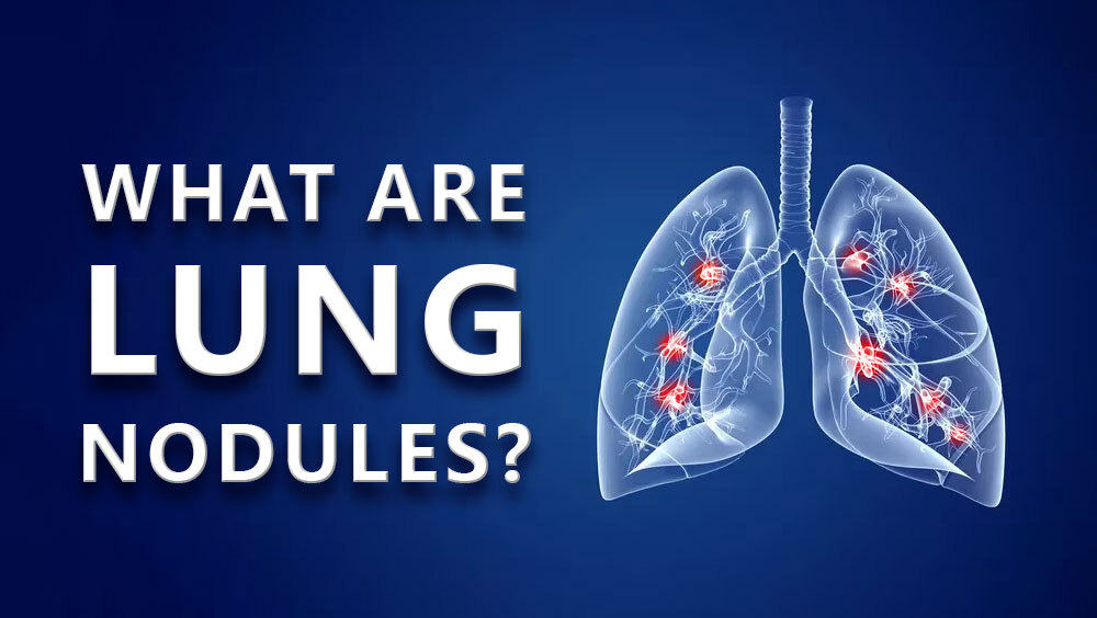 What Are Lung Nodules?