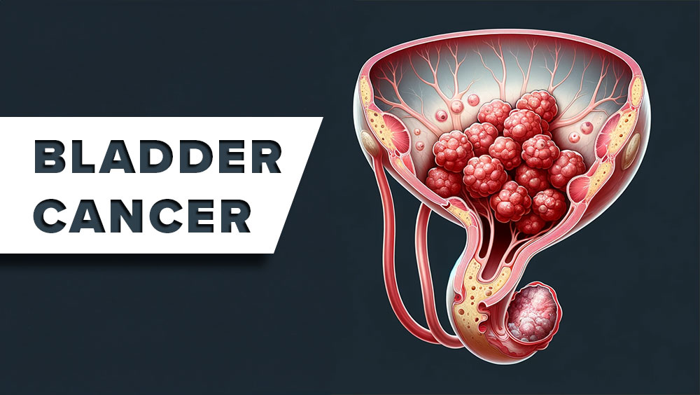 Bladder Cancer Signs & Symptoms