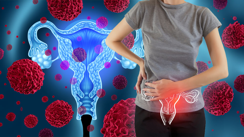 Cervical Cancer Signs & Symptoms
