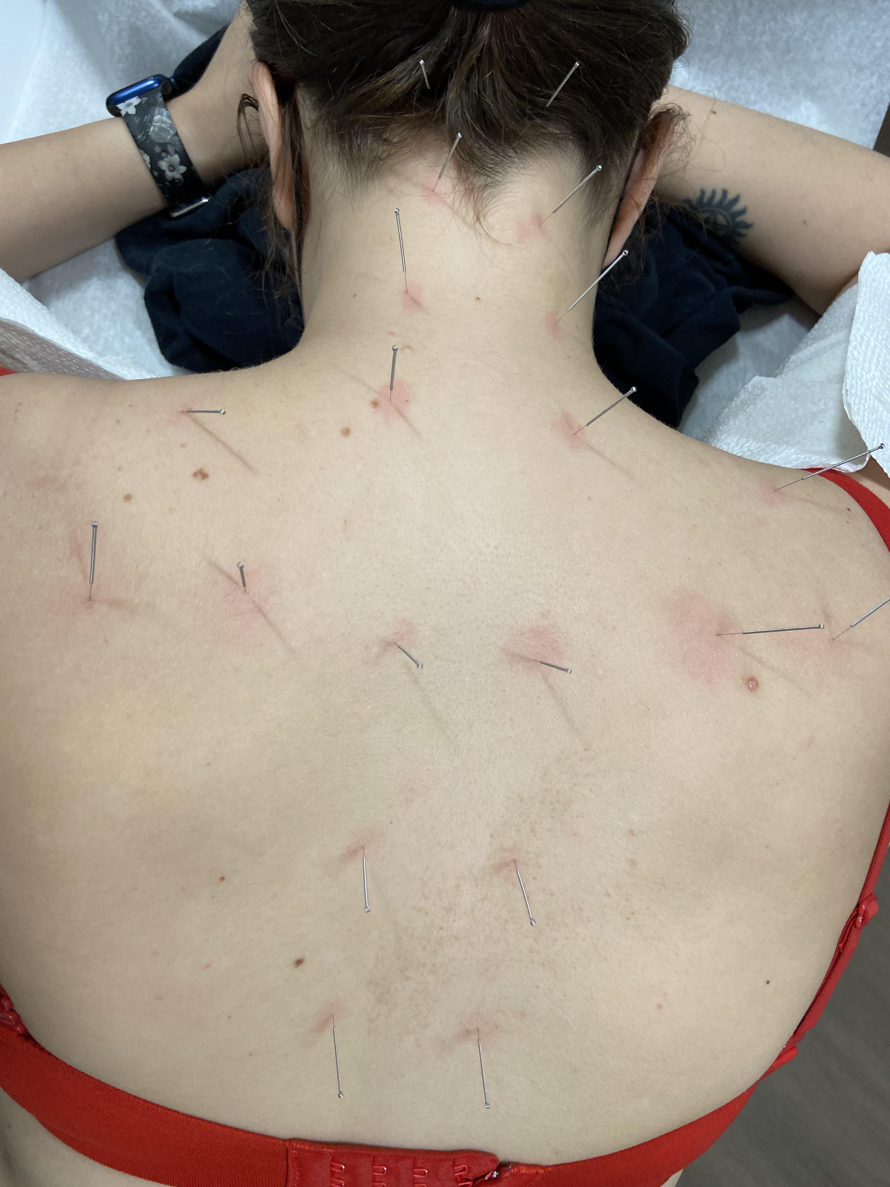 Acupuncture