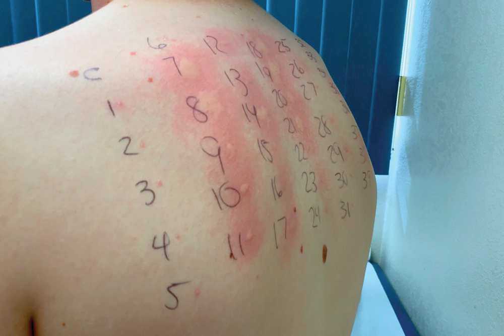 Allergy Testing