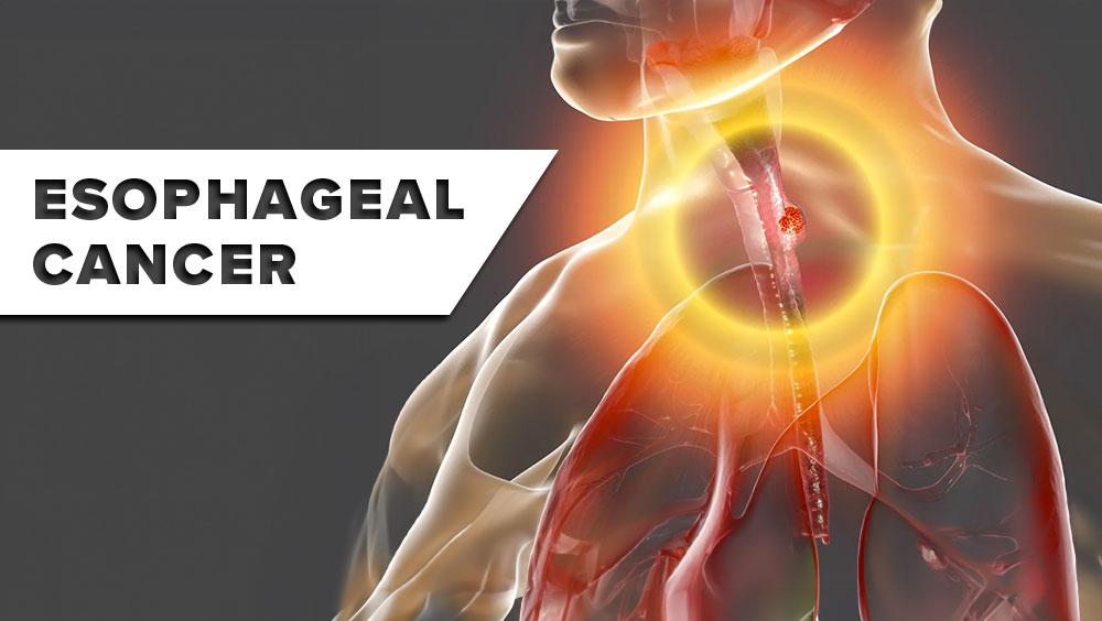 Esophageal Cancer Signs & Symptoms