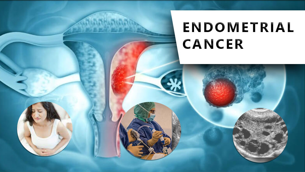 Endometrial Cancer Signs & Symptoms