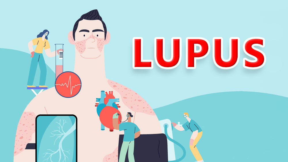 Symptoms Of Lupus