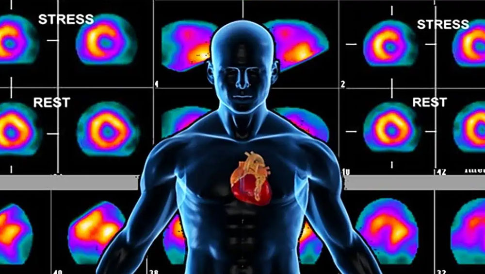 What To Expect During A Nuclear Stress Test