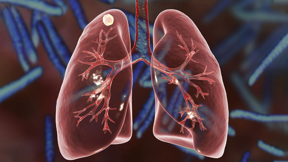 What Are Lung Nodules