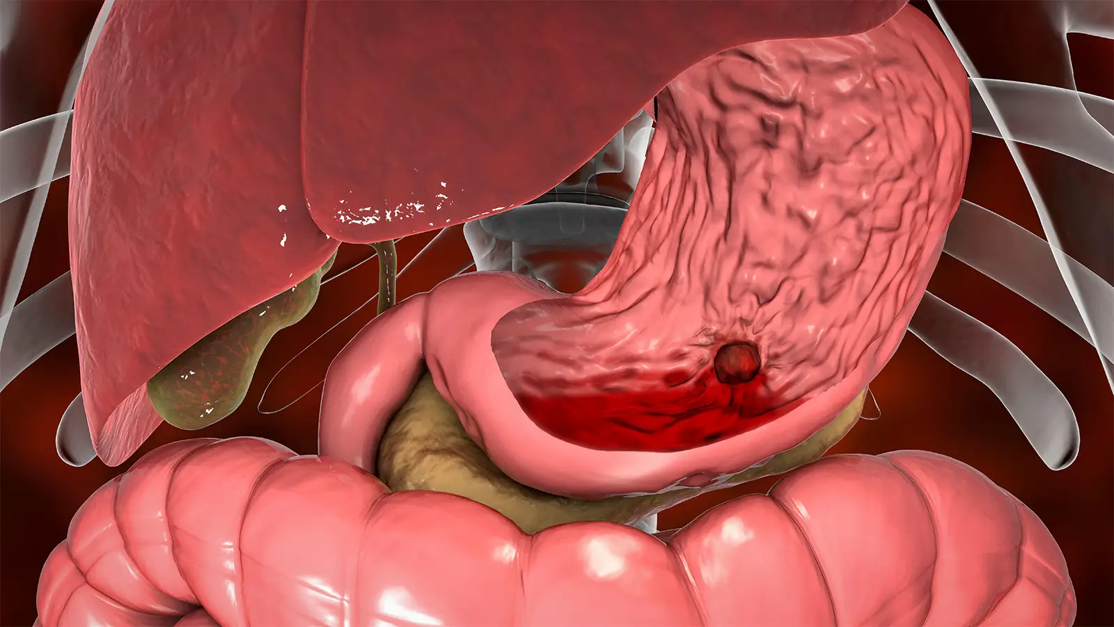 stomach bleeding
