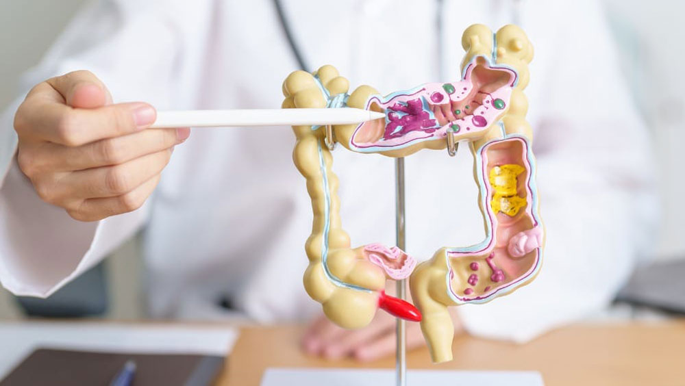 Diverticulitis Remedies