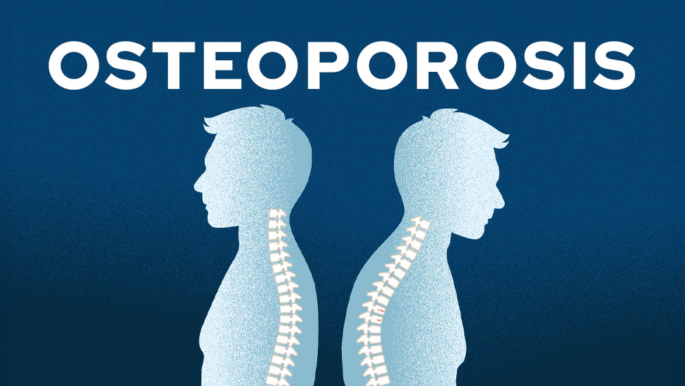Osteoporosis Symptoms