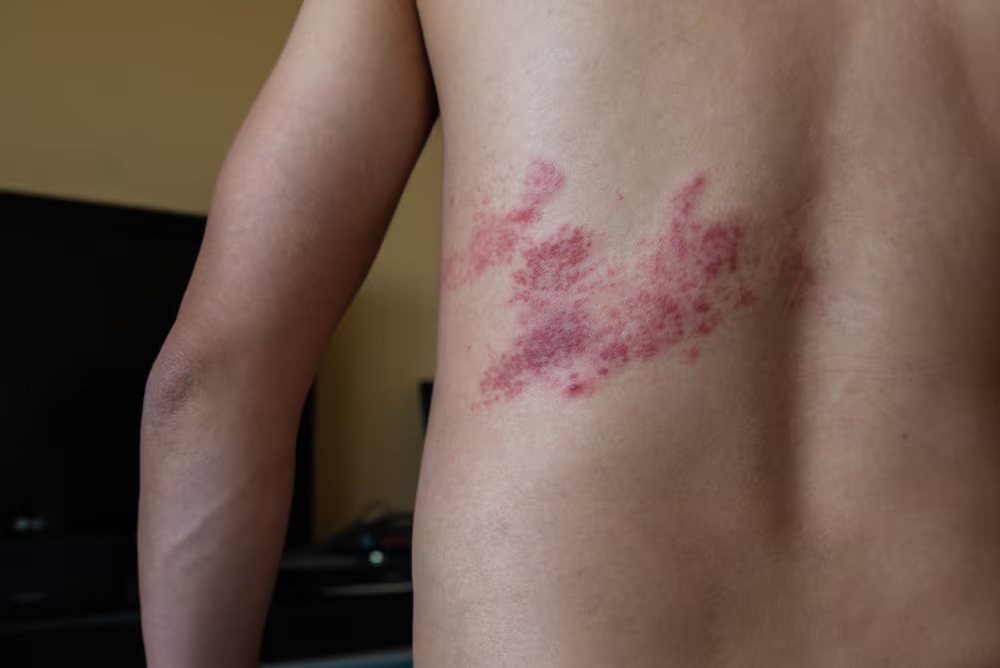shingles rash