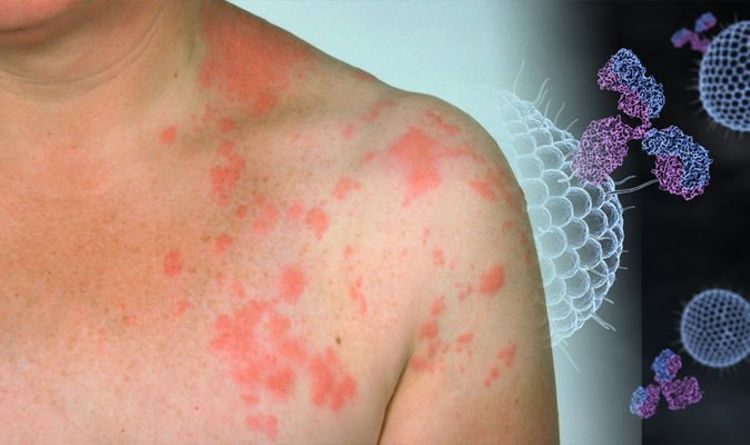 shingles transfer