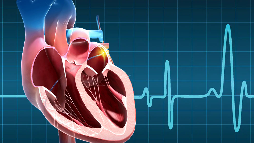 What Is A Cardiac Ablation