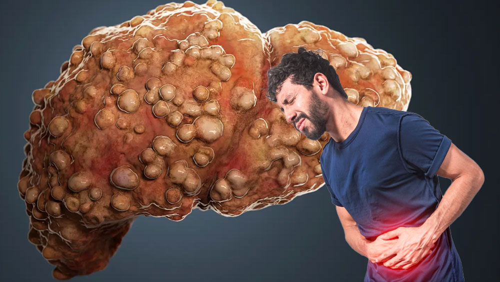 Symptoms Of Liver Cirrhosis