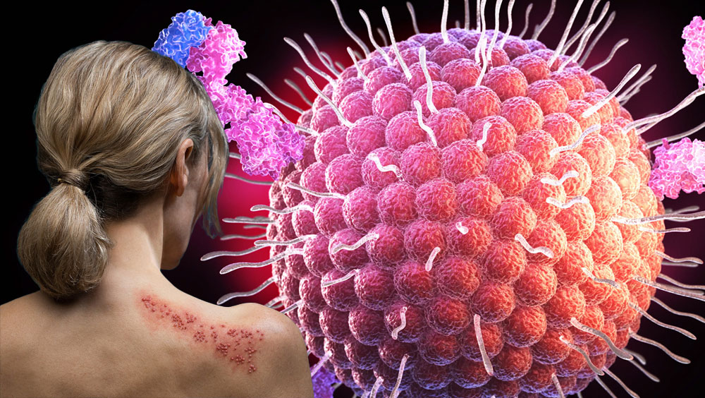 How Contagious Is Shingles