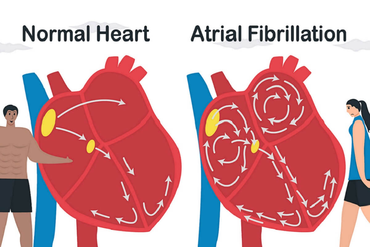 atrialfib