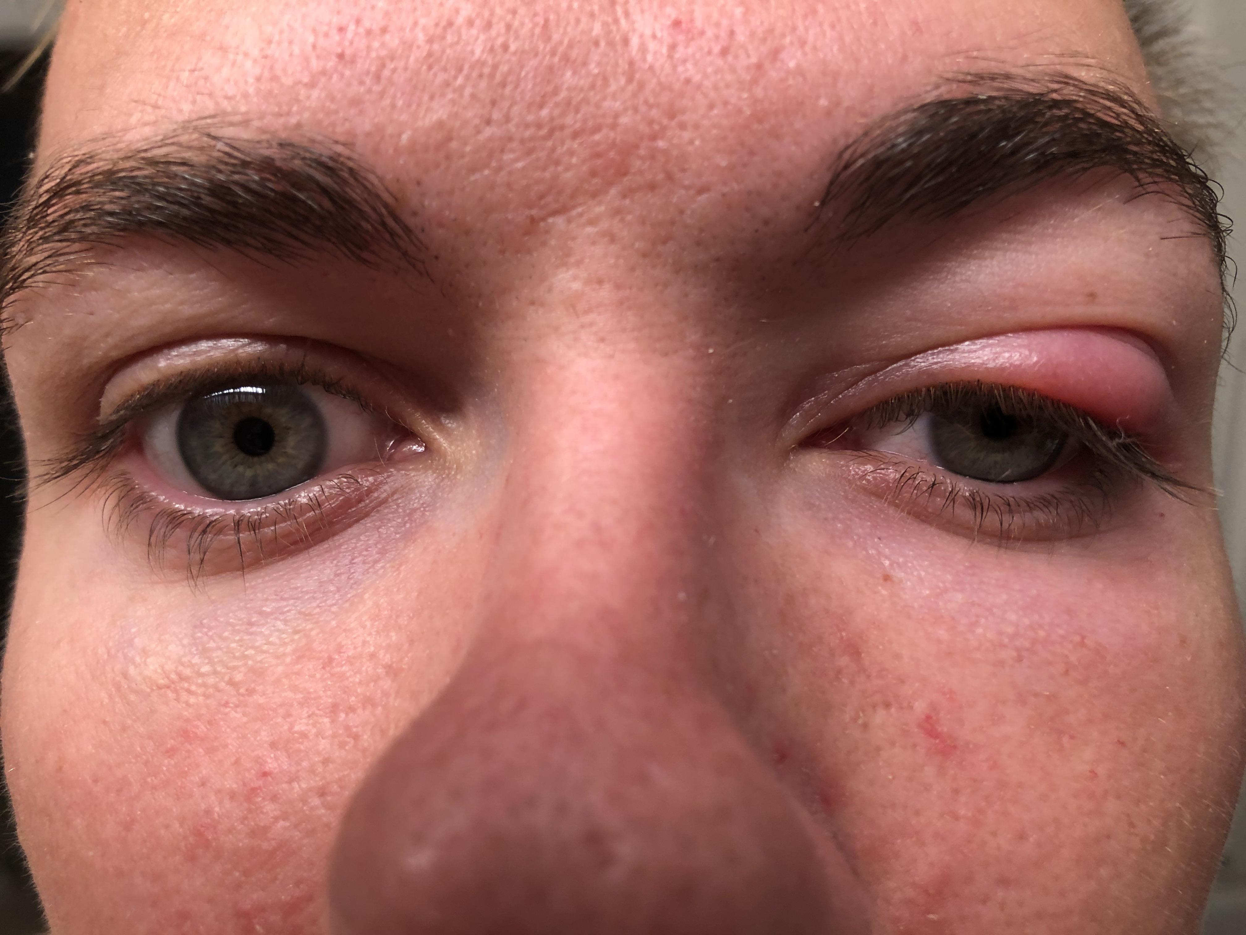 swollen