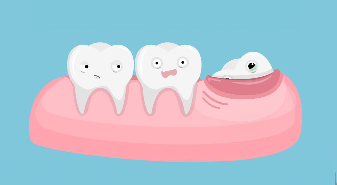 at what age does your wisdom teeth come in_1ce9cc91 f6ee 4b80 97b6 cae2af7520c8