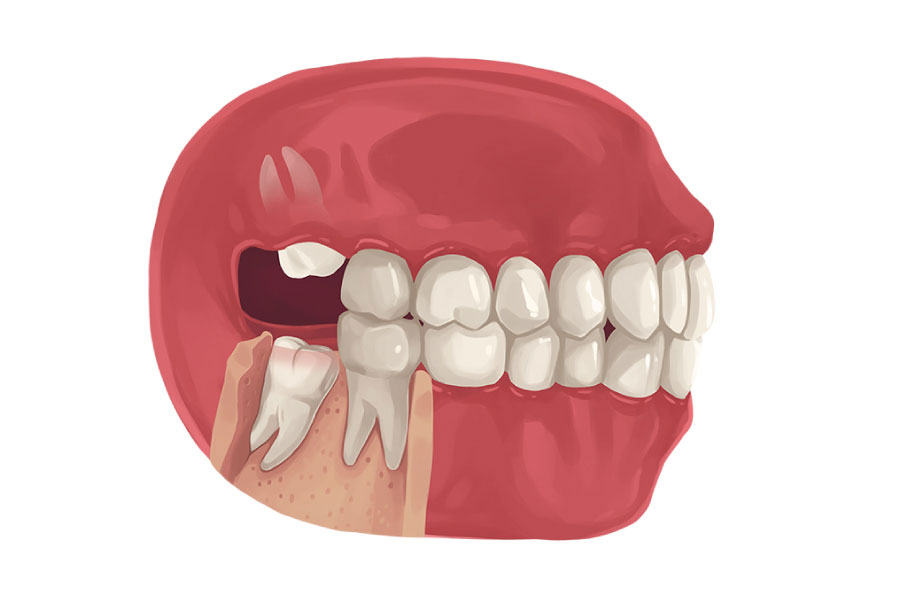 at what age does your wisdom teeth come in_20ed6894 269d 4b88 851f 1b93de2b28e3