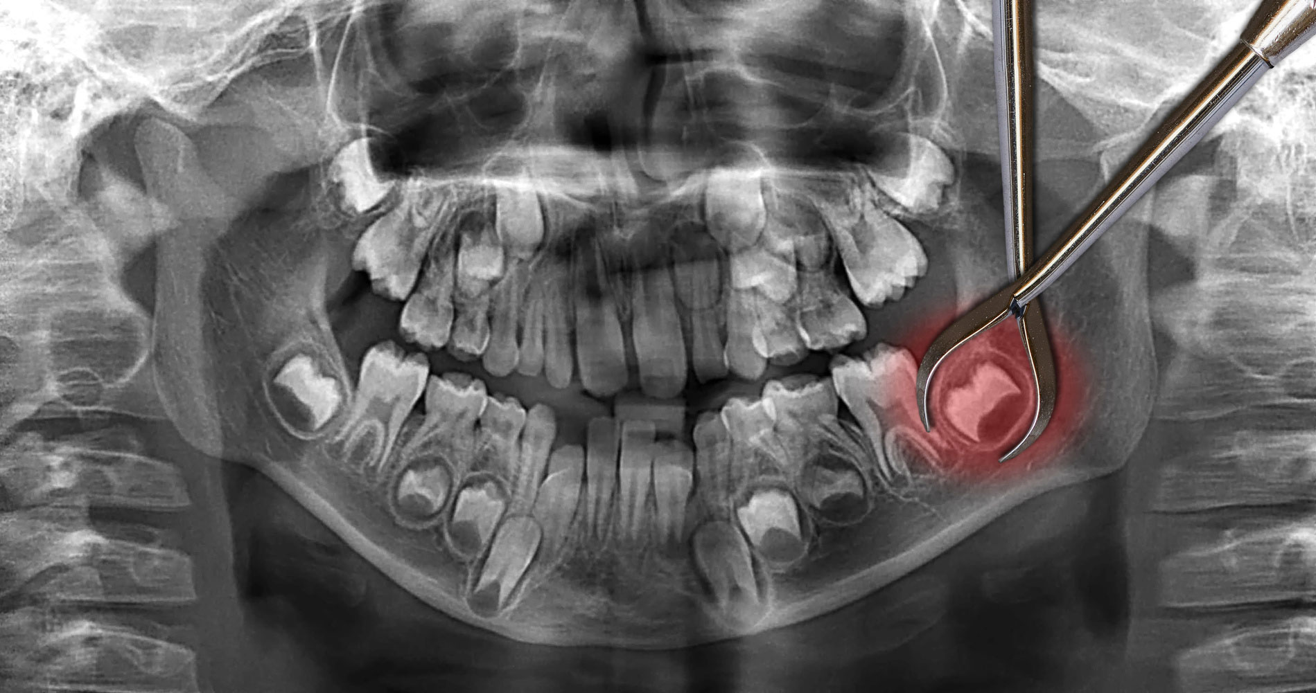at what age does your wisdom teeth come in_402862f5 f0f1 4e78 81e9 41556b4bbe60