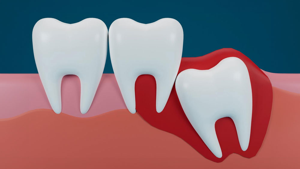At What Age Does Your Wisdom Teeth Come In