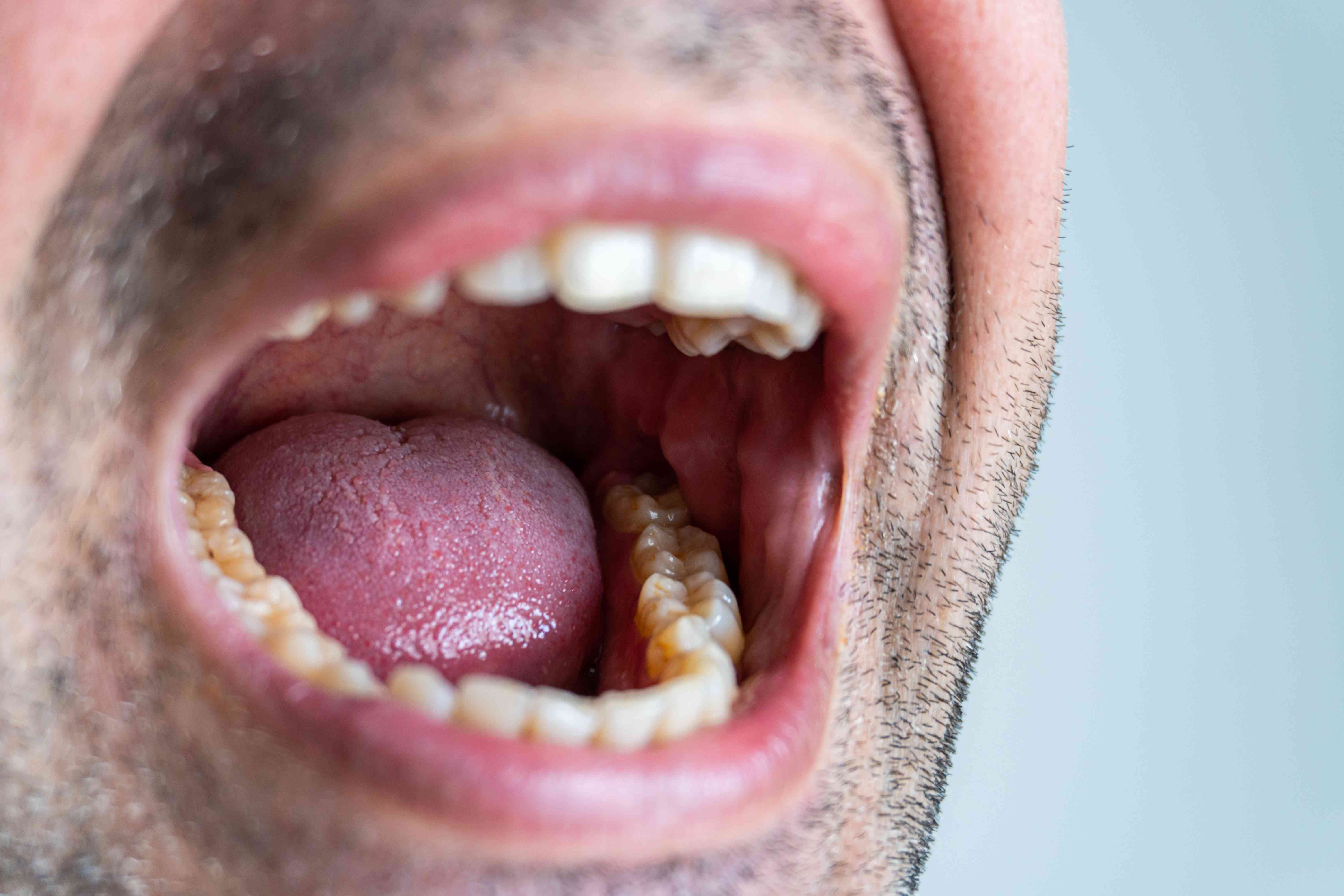 at what age does your wisdom teeth come in_a505c6a0 2140 492b 8371 23cdf242eaaa