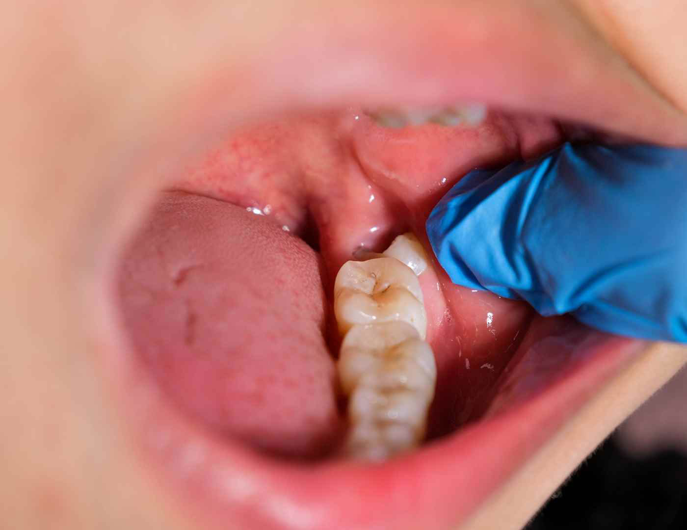 at what age does your wisdom teeth come in_fb4585d1 e5b5 43eb a0e0 505e81cb07cc