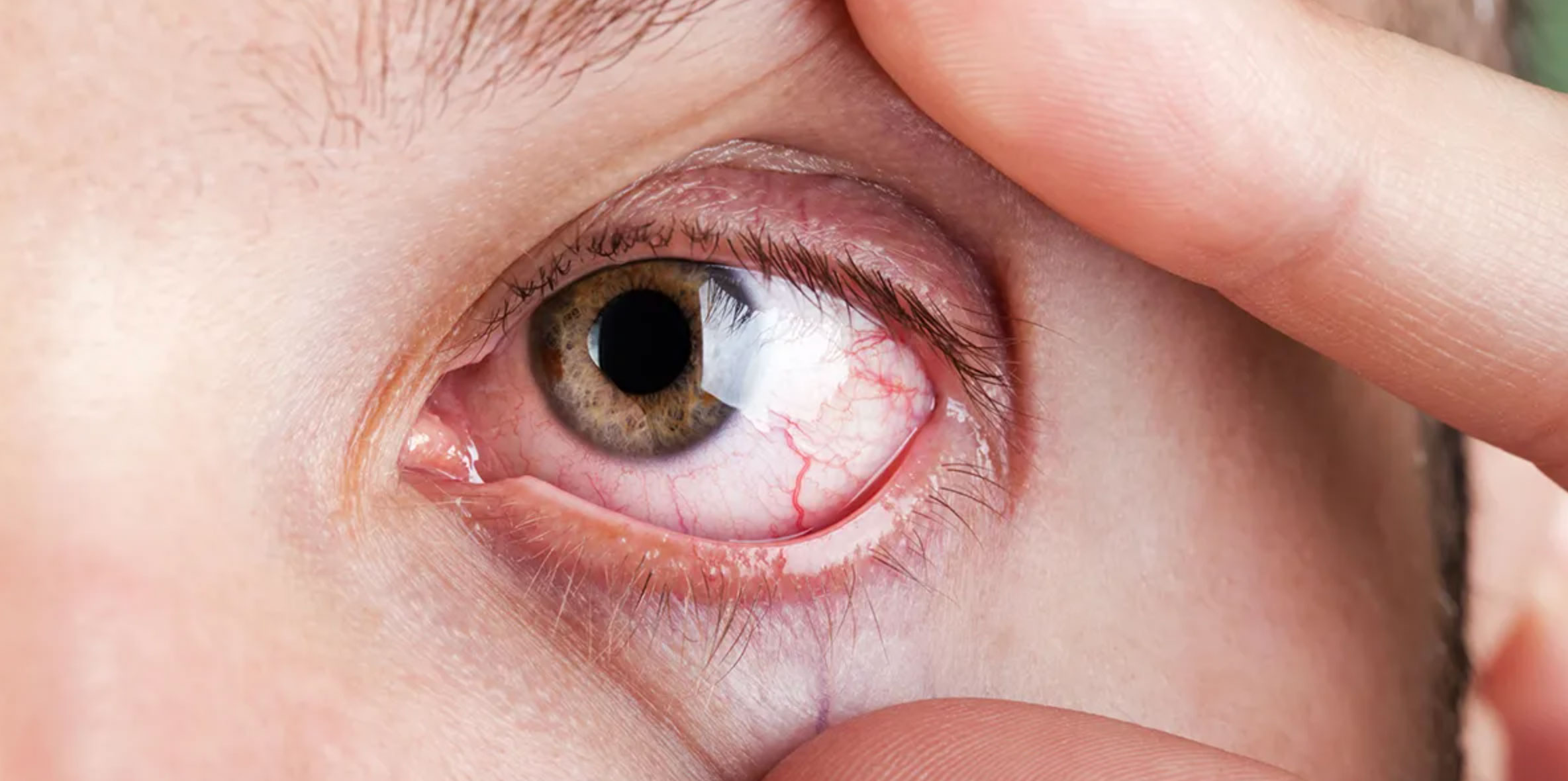 why your eyes burn when you cry_d20d50da 3ae0 4666 a81f 2262cf40ad32