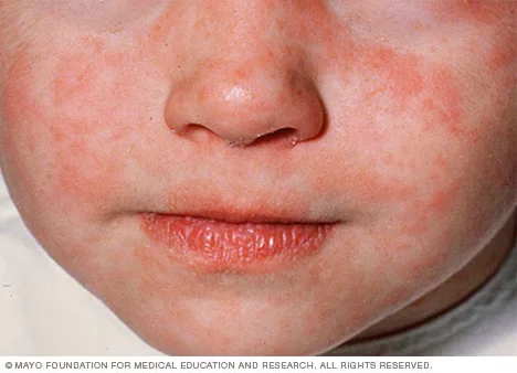 Measles: Symptoms, Transmission, and Prevention Guide