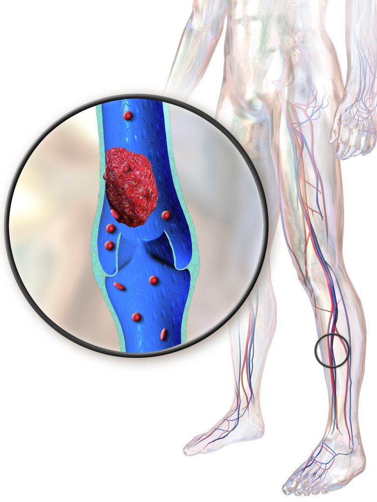 1792513714019_Blausen_0290_DeepVeinThrombosis